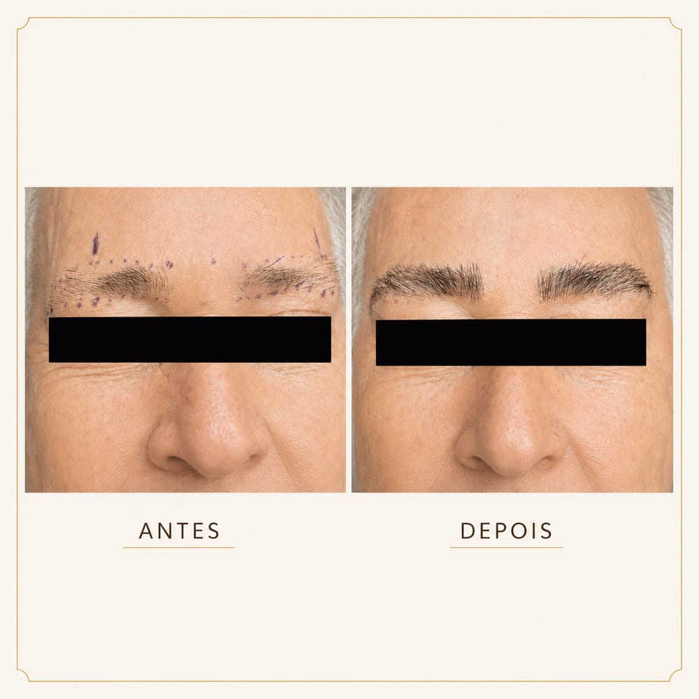 Antes e depois — sobrancelhas simétricas | LiCap Antes e depois de transplante de sobrancelhas — simetria — na LiCap em Florianópolis/SC